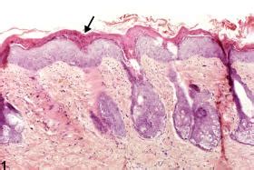 Hyperkeratosis Histology