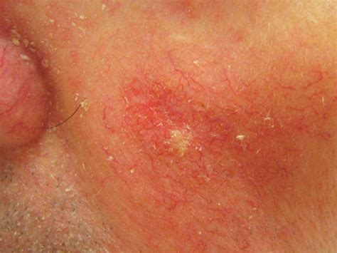 Actinic Keratosis - Pictures, Causes and Treatment