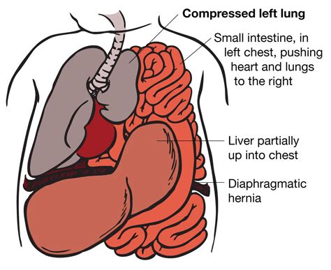 Illustration of CDH with lung compression | Heart and lungs, Medicine ...