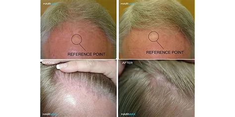 Laser Hair Growth Cap RegrowMD 2