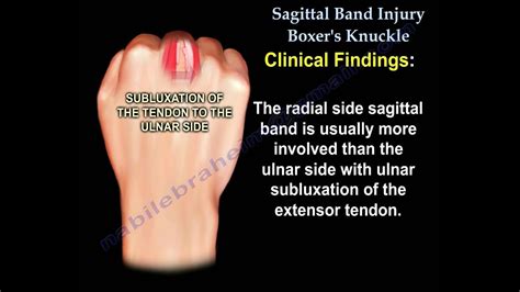 Sagittal Band Injury Boxer's Knuckle - Everything You N... | Doovi