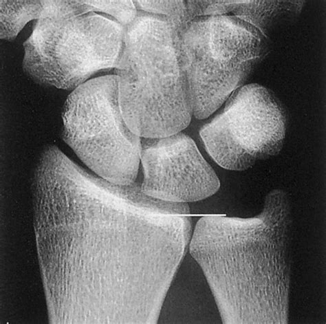 Ulnar Variance - Hand - Orthobullets