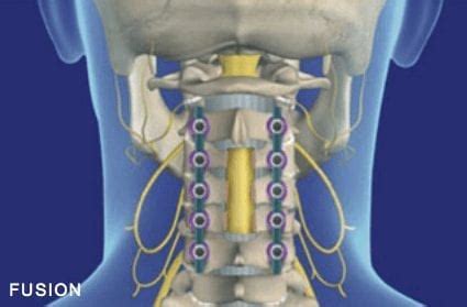 Laminectomy Recovery Time | How long will a Laminectomy take to heal?