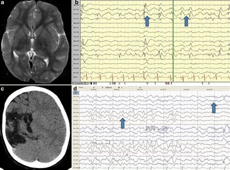 The preoperative a MRI and b EEG along with the postoperative c CT scan... | Download Scientific ...