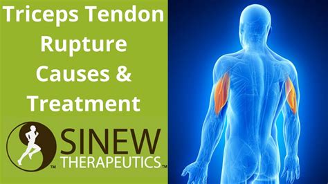 Triceps Tendon Rupture Causes and Treatment - YouTube