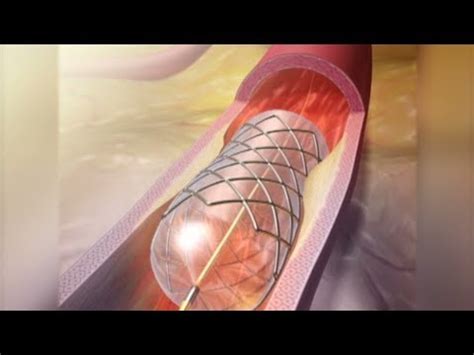 Complications of Stent - YouTube