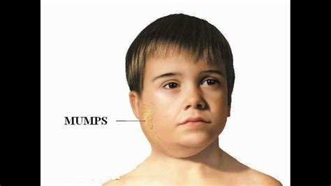 Biggest mumps outbreak in 22 years occurring in Texas | newswest9.com