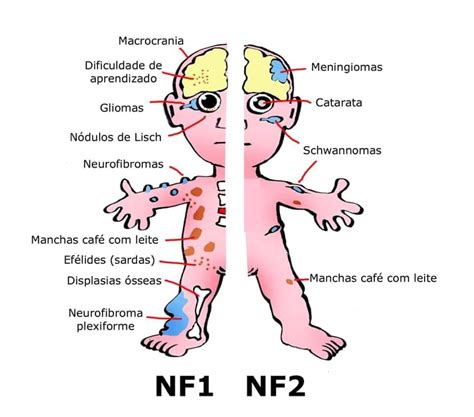 Neurofibromatosis Type 3