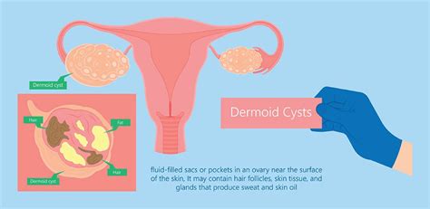 Dermoid Cyst Ovary Eye