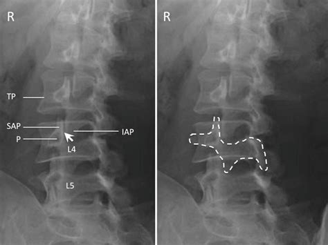 Lumbar Facet Joint and Nerve Injection | Anesthesia Key