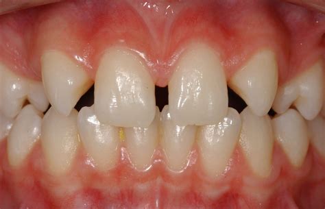 Missing Teeth - Forbes Orthodontics