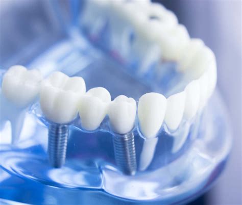 Mini Dental Implants - Albuquerque Dentist | Dental Implants | Cosmetic ...