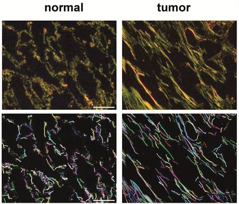 Researchers identify new biomarkers of the most frequent lung cancer