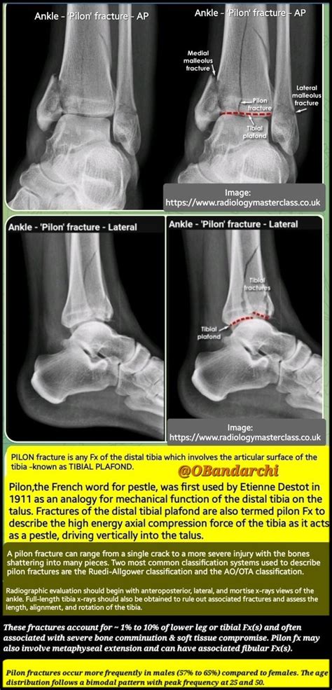 Will 🦴🛠💪🏼 on Twitter: "RT @OBandarchi: 🛑A Pilon Fracture (=tibial plafond Fx) is any Fx of ...