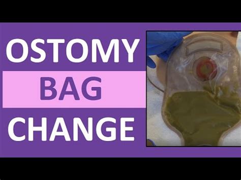 Ostomy Bag Pouch Change | Ostomy Care Nursing | Colostomy, Ileostomy ...