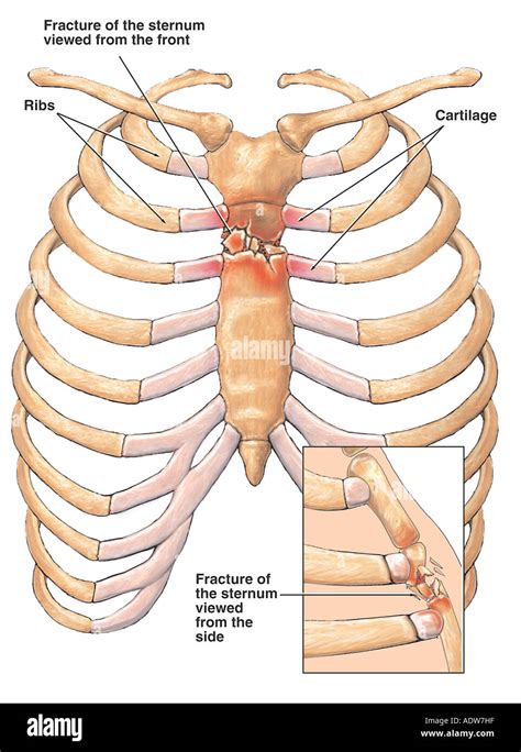 Fractured clavicle hi-res stock photography and images - Alamy