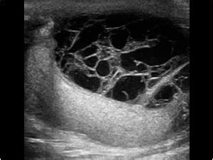 Spermatocele Ultrasound