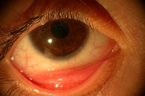 Vernal keratoconjunctivitis (VKC) | www.ocular-surface.org