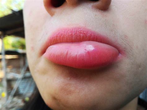 Swollen Bottom Lip, Causes, For No Reason, Treatment of Lower Lips Swelling - American Celiac