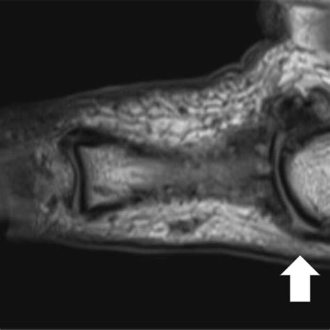 Coronal reconstruction of T2 weighted MRI scan of thumb indicating RCL ...