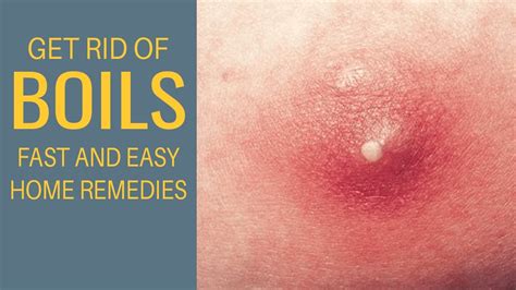 Get Rid Of Boils Fast At Home - Remedies For Boils - YouTube