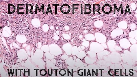 Dermatofibroma with hemosiderin laden Touton giant cells (pathology dermpath dermatology) - YouTube