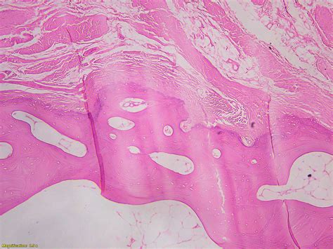 Pathology Outlines - Myositis ossificans and fibro-osseous pseudotumor ...