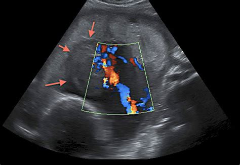 Placental Chorioangioma - Journal of Obstetrics and Gynaecology Canada