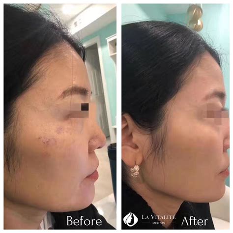 PicoWay® Laser Pigmentation Removal in Toronto & North York | La Vitalité Med Spa