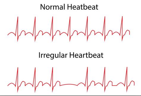 Symptoms of Arrhythmia - MBBCH Health Encyclopedia