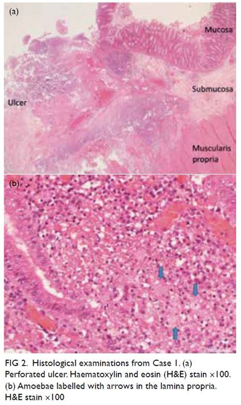 Fulminant necrotising amoebic colitis: a report of two cases | HKMJ