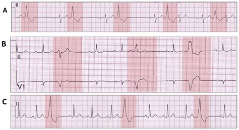 The Electrocardiographic Footprints of Ventricular Ectopy - Heart, Lung ...