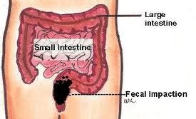 Fecal Impaction | Survival Medicine | Doom and Bloom (TM) | Doom and Bloom (TM)