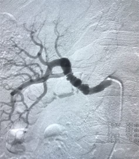 Renal Artery Stenosis - SAI Nephrology