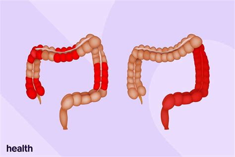 Crohn’s and Colitis: Similarities and Differences