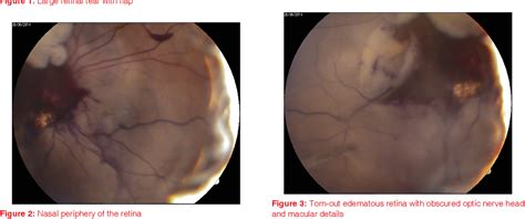 Figure 3 from A typical case of optic nerve head avulsion | Semantic ...