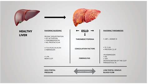 Individualized Management of Coagulopathy in Patients with End-Stage Liver Disease