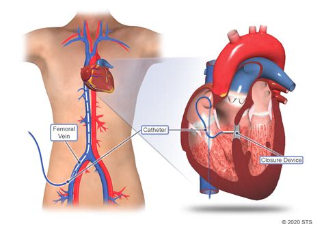 Ventricular Septal Defect Surgery | The Patient Guide to Heart, Lung ...