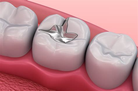 What Dental Fillings Should You Get? - TAG Dental Clinic