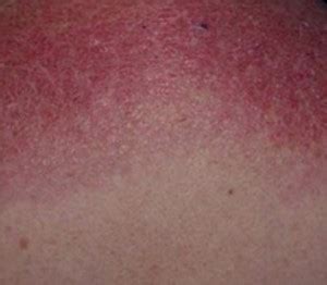 Dermatomyositis Rash - Pictures, Symptoms, Causes, Treatment