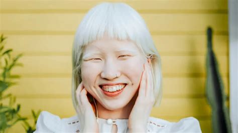 Can Albino People Dye Their Hair? Everything You Need to Know - After SYBIL