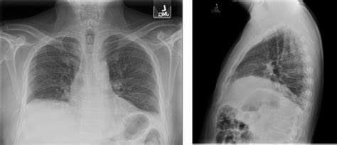 Hemidiaphragm With Bibasilar Atelectasis. Posteroanterior and lateral ...