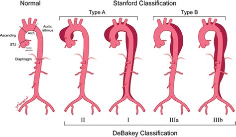 Thoracic Aortic Aneurysm Classification