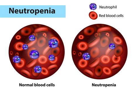 What is Absolute Neutrophil Count (ANC) and How is it Measured in Blood ...