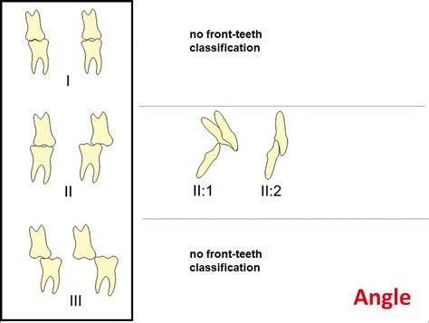 The bite-type malocclusion classification – An extended Angle-method ...