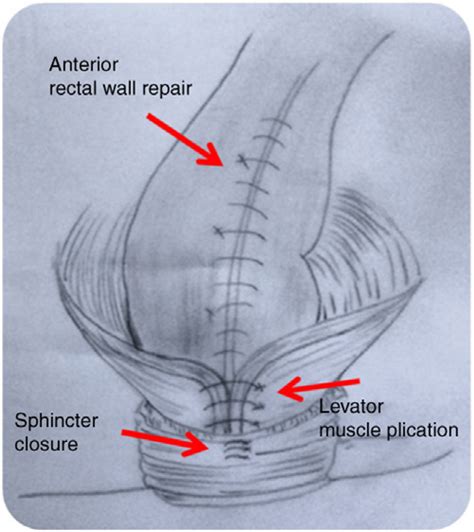 SciELO - Brasil - Repair of the middle and posterior compartments of ...