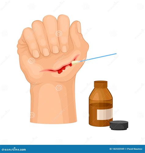 Hand with Wound Streaming Blood Cleaning with Pharmaceutical Substance ...