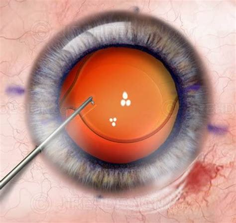 Toric IOL implant surgery - #SUCA0060 | Stock eye images