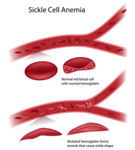 Sickle Cell Anemia Mutation