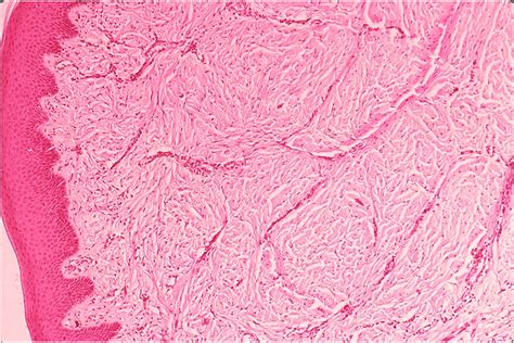 Epulis Fissuratum Histologie